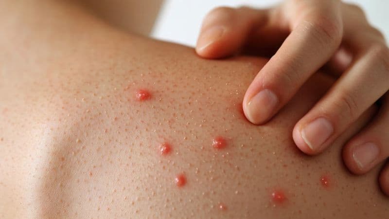 Insta Congreso a reforzar acciones vs contagios de sarampión en el Estado